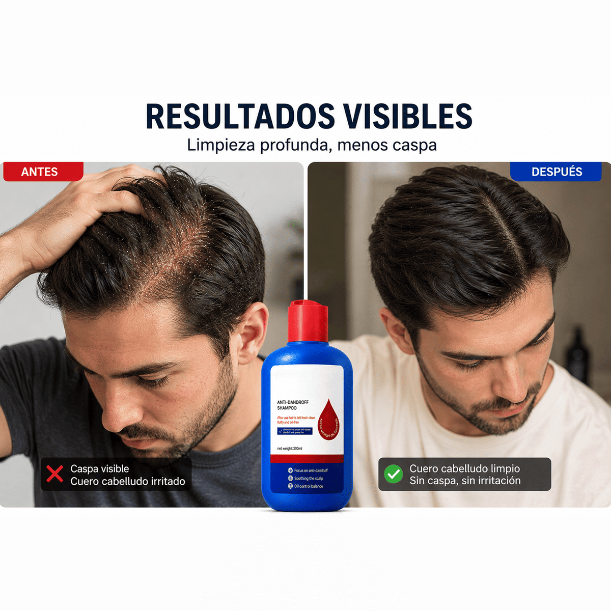 Adiós a la caspa y la descamación visible